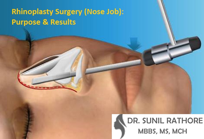 Nose job in Bhopal